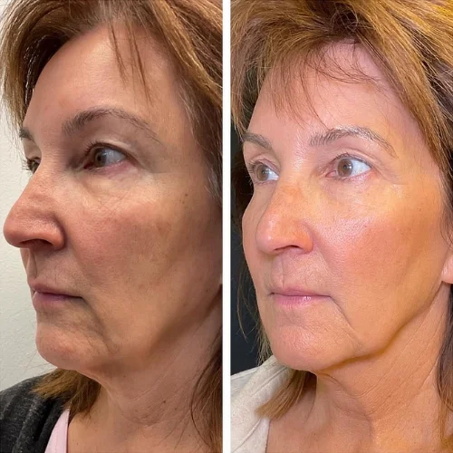 Morpheus8 RF Microneedling Before and After Treatment | Lounge of Beauty Medical Spa