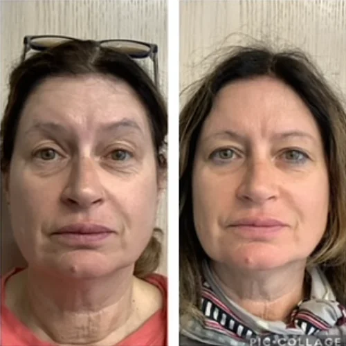 PDO Thread Lift at Lounge of Beauty Medical Spa2