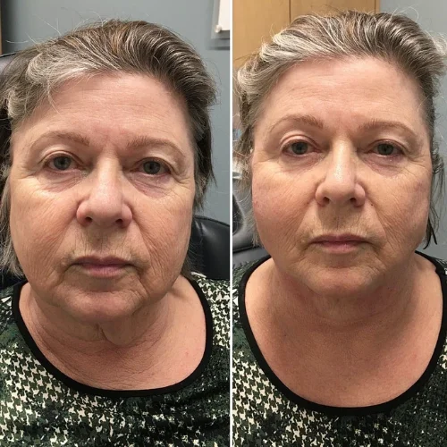 PDO Thread Lift at Lounge of Beauty Medical Spa 6