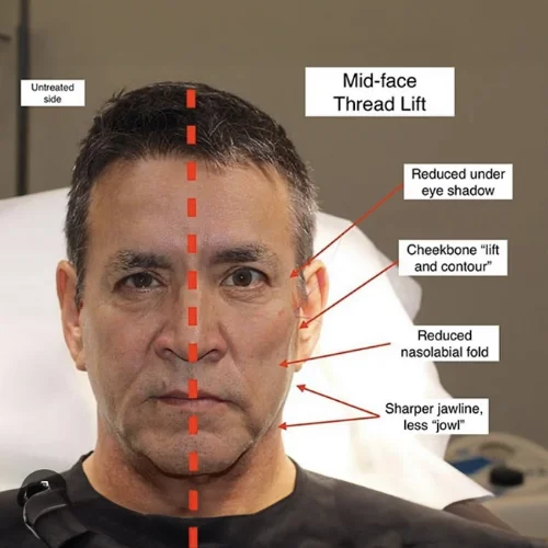 PDO Thread Lift at Lounge of Beauty Medical Spa