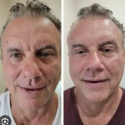 PDO Thread Lift at Lounge of Beauty Medical Spa1