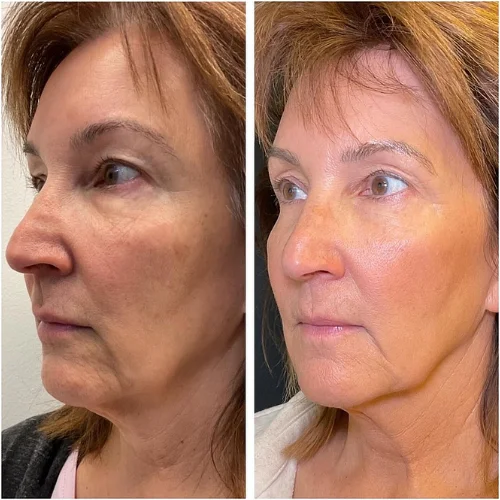 PDO Thread Lift at Lounge of Beauty Medical Spa 4