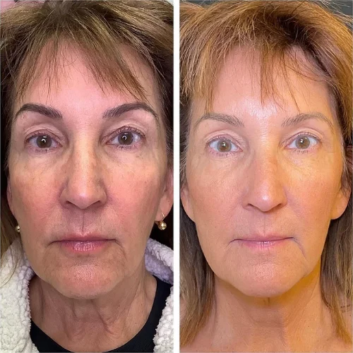 PDO Thread Lift at Lounge of Beauty Medical Spa 5