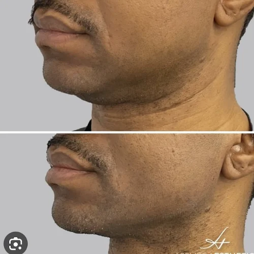 Sculptra Before and After Treatment | Lounge of Beauty Medical Spa