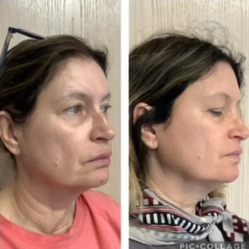 Sculptra Before and After Treatment | Lounge of Beauty Medical Spa