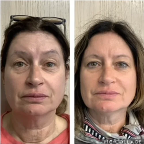 Sculptra Before and After Treatment | Lounge of Beauty Medical Spa